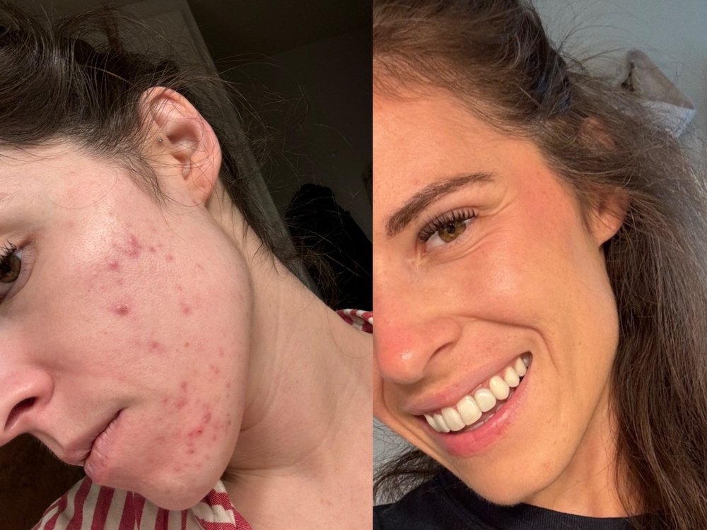 Abby before and after — clearer skin and balanced mood