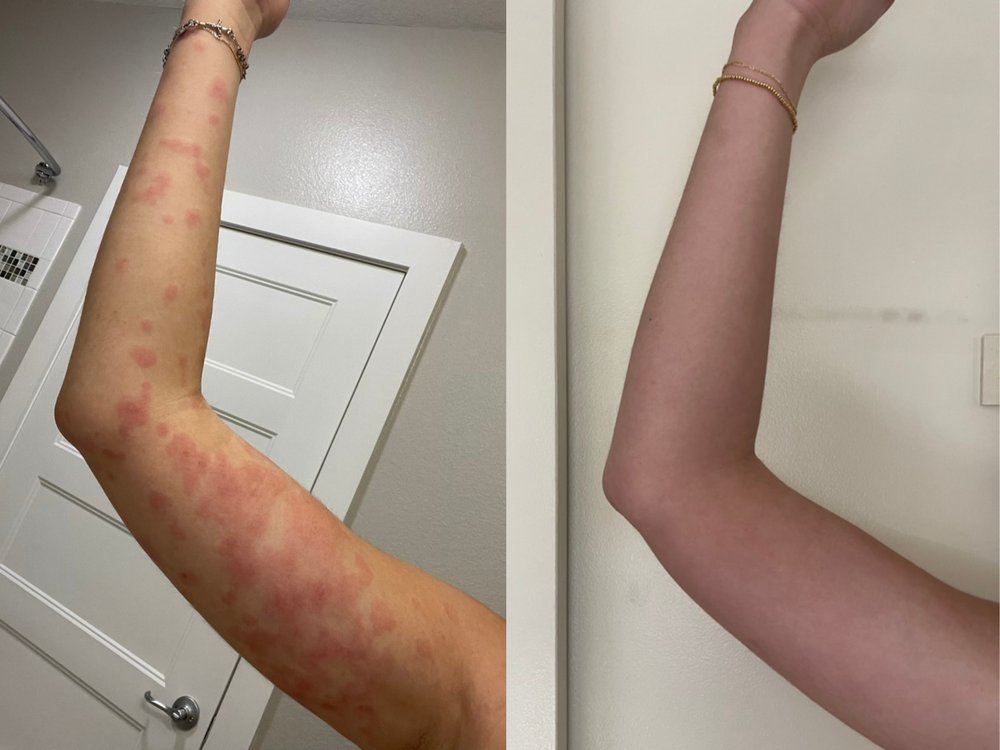 Ashley before and after — chronic hives cleared