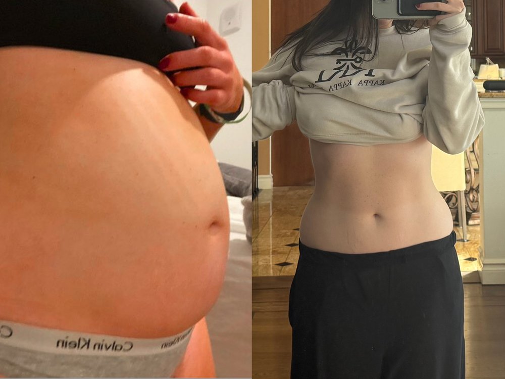 Laura before and after — reduced bloating after meals