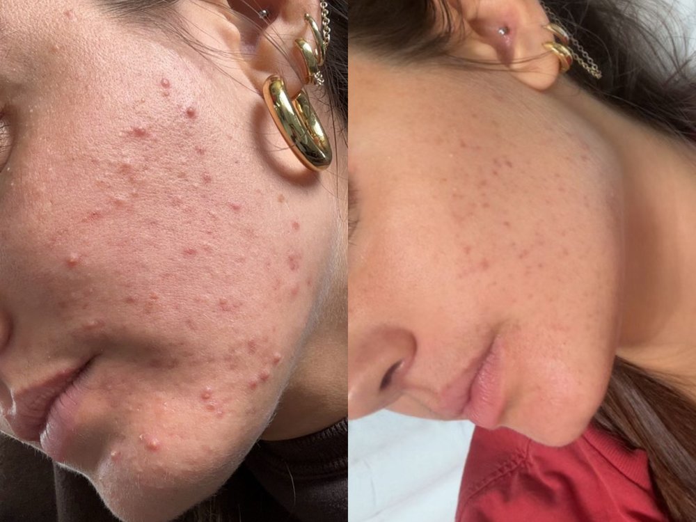 Zophia before and after — clearer skin and less brain fog